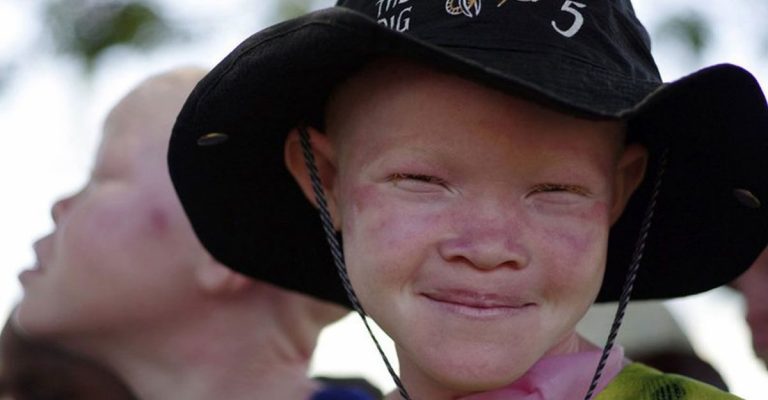 Afrique : une adolescente albinos rejetée trouve la paix en Jésus : « Dieu m’a faite belle ! »