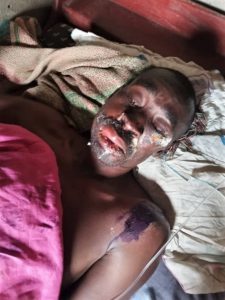 Un pasteur attaqué à l'acide en Ouganda après avoir prêché un sermon